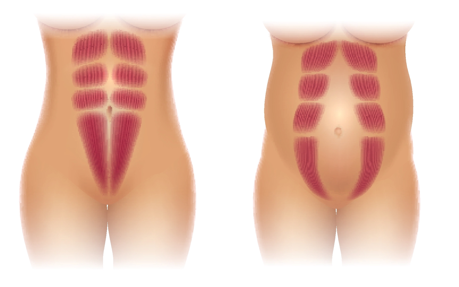 Rectus Abdominus Muscle as affected by pregnancy