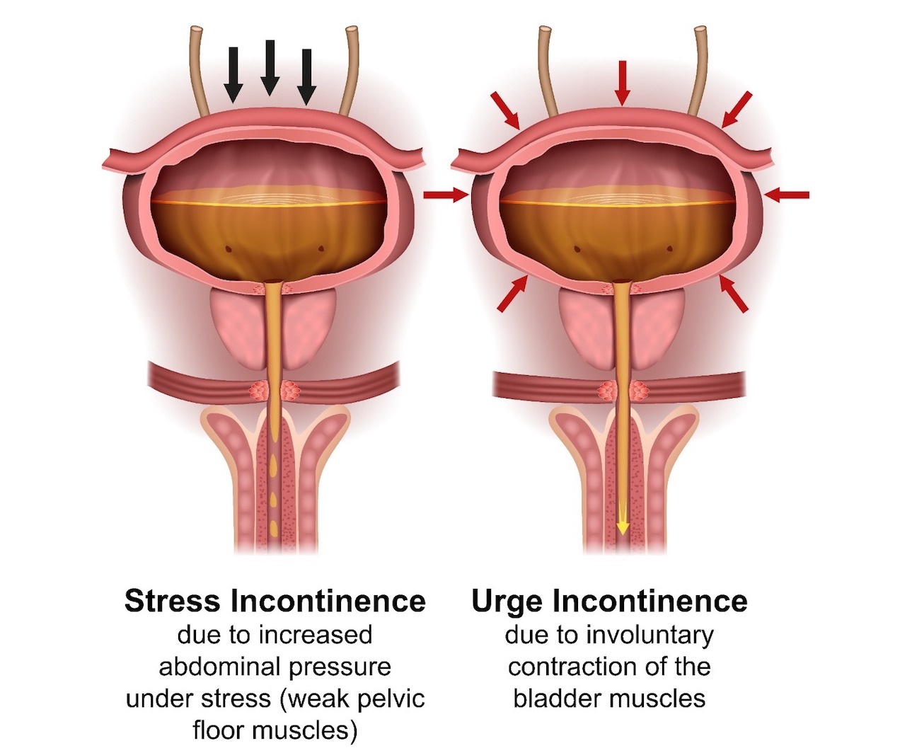stress incontinence