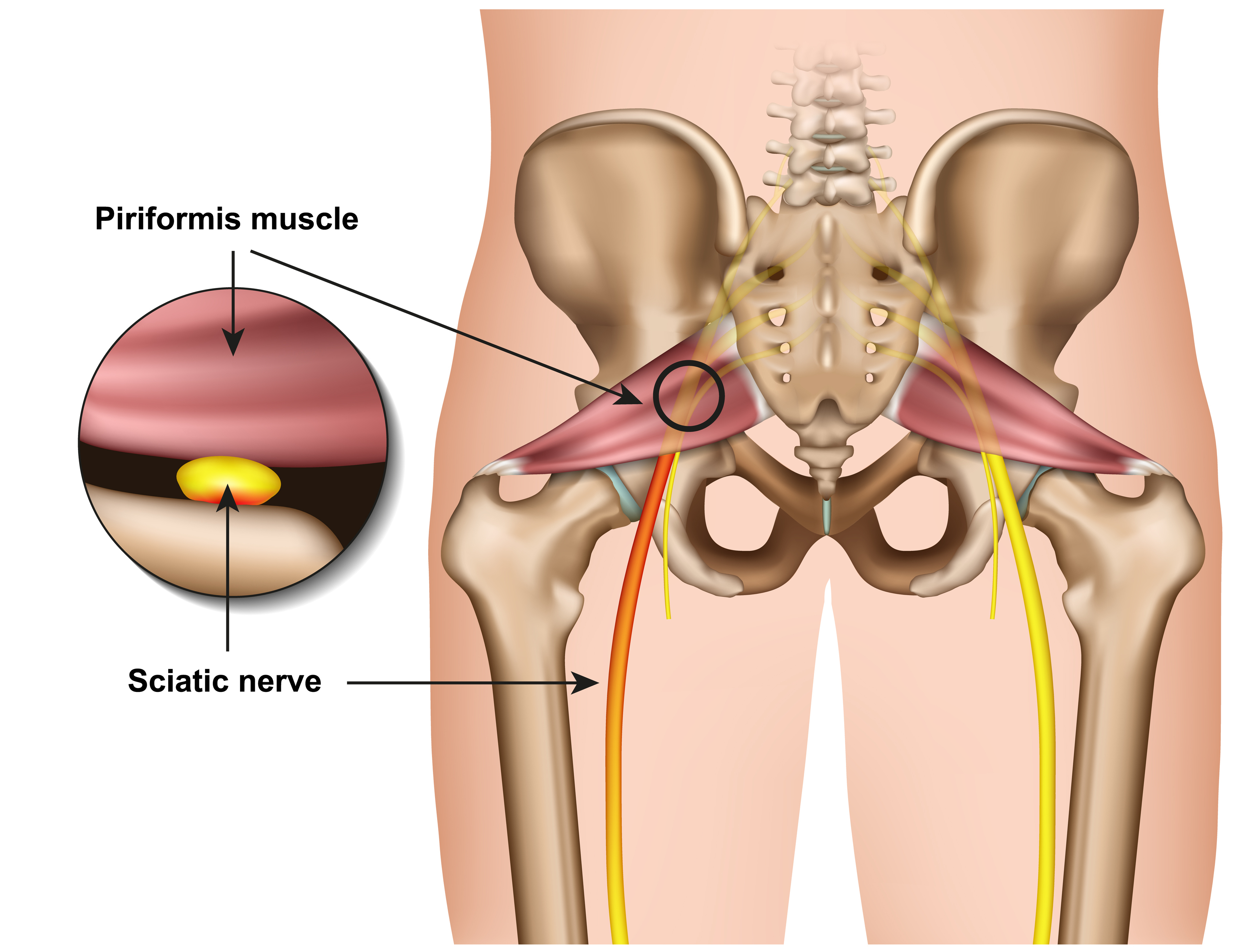 Anatomy of sciatica